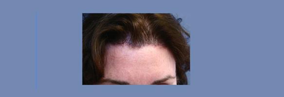brow lift, browlift, forehead lift, facelift.